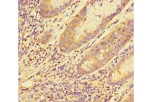 Immunohistochemistry of paraffin-embedded human colon cancer using ABIN7159120 at dilution of 1:100 (MED29 anticorps  (AA 1-212))