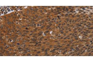 Immunohistochemistry of paraffin-embedded Human cervical cancer tissue using PNOC Polyclonal Antibody at dilution 1:40 (PNOC anticorps)