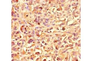Immunohistochemistry of paraffin-embedded human melanoma using ABIN7155270 at dilution of 1:100 (KAT2B anticorps  (AA 767-832))