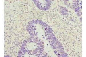 Immunohistochemistry of paraffin-embedded human ovarian cancer using ABIN7176735 at dilution of 1:100