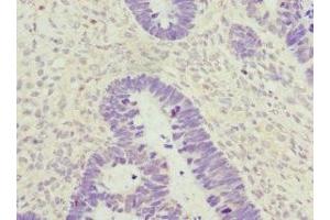 Immunohistochemistry of paraffin-embedded human ovarian cancer using ABIN7176735 at dilution of 1:100 (ZWINT anticorps  (AA 1-277))
