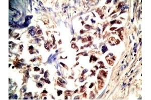Human lung cancer tissue stained by Rabbit Anti-CRAMP(140-173) (Mouse) Antibody (Cathelicidin anticorps  (AA 140-173))