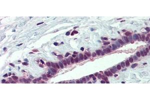 Rabbit Anti-PCBP1 Antibody  arp40631 Paraffin Embedded Tissue: Human Breast Antibody Concentration: 5 ug/ml