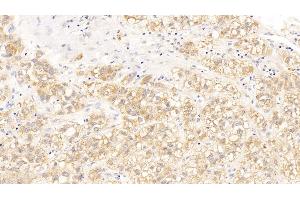 Detection of CDKN1A in Human Liver cancer Tissue using Polyclonal Antibody to Cyclin Dependent Kinase Inhibitor 1A (CDKN1A)