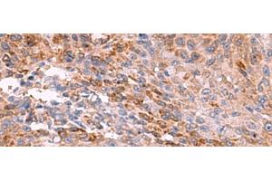Immunohistochemistry of paraffin-embedded Human colorectal cancer tissue using PEMT Polyclonal Antibody at dilution of 1:55(x200) (PEMT anticorps)