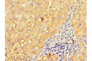 Immunohistochemistry of paraffin-embedded human liver cancer using ABIN7157008 at dilution of 1:100 (Inversin anticorps  (AA 1-101))