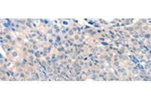 Immunohistochemistry of paraffin-embedded Human cervical cancer tissue using SLC17A6 Polyclonal Antibody at dilution of 1:100(x200)