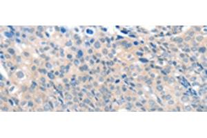 Immunohistochemistry of paraffin-embedded Human cervical cancer tissue using SLC17A6 Polyclonal Antibody at dilution of 1:100(x200) (Solute Carrier Family 17 (Vesicular Glutamate Transporter), Member 6 (SLC17A6) anticorps)