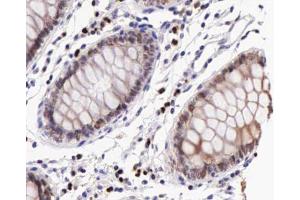 ABIN6267227 at 1/200 staining human colon cancer tissue sections by IHC-P. (IKBKB anticorps  (pTyr199))