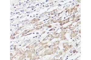 Immunohistochemistry of paraffin-embedded Human liver cancer using IGFBP1 Polyclonal Antibody at dilution of 1:100 (40x lens). (IGFBPI anticorps)