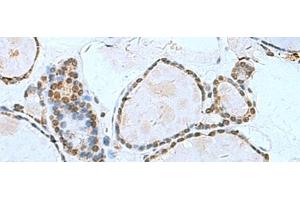 Immunohistochemistry of paraffin-embedded Human thyroid cancer tissue using L3MBTL2 Polyclonal Antibody at dilution of 1:70(x200)