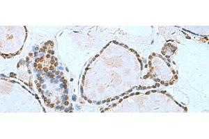 Immunohistochemistry of paraffin-embedded Human thyroid cancer tissue using L3MBTL2 Polyclonal Antibody at dilution of 1:70(x200) (L3MBTL2 anticorps)