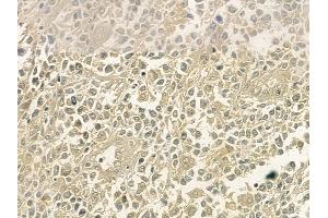 ABIN6254902 and ABIN6267061 at 1/100 staining human non-Hodgkin lymphoma by IHC-P.