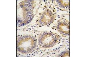Formalin-fixed and paraffin-embedded human colon carcinoma tissue reacted with LEFTB antibody (C-term), which was peroxidase-conjugated to the secondary antibody, followed by DAB staining.