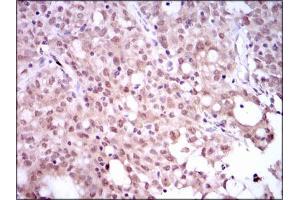 Immunohistochemical analysis of paraffin-embedded cervical cancer tissues using SRY mouse mAb with DAB staining. (SRY anticorps  (AA 1-204))