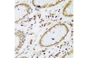 Immunohistochemistry of paraffin-embedded human gastric using UBE3A antibody at dilution of 1:200 (40x lens). (ube3a anticorps)