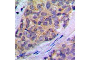 Immunohistochemical analysis of PLA2G4A (pS505) staining in human breast cancer formalin fixed paraffin embedded tissue section.