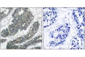 Immunohistochemistry analysis of paraffin-embedded human breast carcinoma tissue, using p62 Dok (Ab-398) Antibody. (DOK1 anticorps  (AA 365-414))