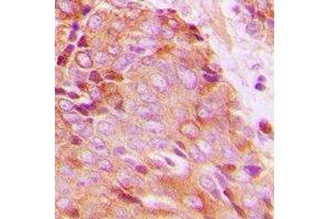 Immunohistochemical analysis of 14-3-3 zeta (pT232) staining in human breast cancer formalin fixed paraffin embedded tissue section. (14-3-3 zeta anticorps  (C-Term, pThr232))