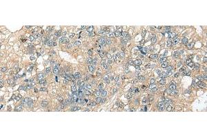 Immunohistochemistry of paraffin-embedded Human gastric cancer tissue using CASR Polyclonal Antibody at dilution of 1:60(x200) (CASR anticorps)