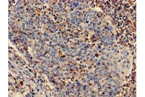 Immunohistochemistry of paraffin-embedded human cervical cancer using ABIN7163564 at dilution of 1:100
