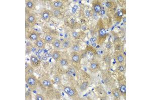 Immunohistochemistry of paraffin-embedded human liver injury using TLK2 antibody at dilution of 1:100 (x40 lens). (TLK2 anticorps)