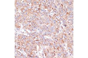 Immunohistochemistry of paraffin-embedded human liver cancer using Y antibody (ABIN6132787, ABIN6150315, ABIN6150320 and ABIN6214108) at dilution of 1:100 (40x lens). (YAP1 anticorps  (AA 155-504))