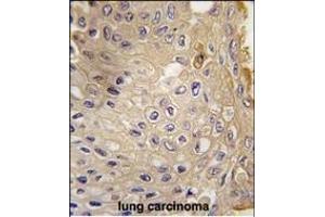 Formalin-fixed and paraffin-embedded human lung carcinoma tissue reacted with G9L1 Antibody  1814i , which was peroxidase-conjugated to the secondary antibody, followed by DAB staining. (ATG9A anticorps  (AA 723-753))