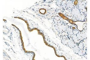 ABIN6260321 and ABIN6277297 at 1/100 staining Human esophageal cancer and adjacent normal tissues by IHC-P.