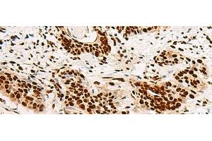 Immunohistochemistry of paraffin-embedded Human esophagus cancer tissue using HNRNPA3 Polyclonal Antibody at dilution of 1:45(x200)
