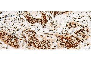 Immunohistochemistry of paraffin-embedded Human esophagus cancer tissue using HNRNPA3 Polyclonal Antibody at dilution of 1:45(x200) (HNRNPA3 anticorps)