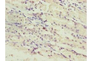 Immunohistochemistry of paraffin-embedded human gastric cancer using ABIN7169284 at dilution of 1:100 (PPP2R3C anticorps  (Regulatory Subunit B))