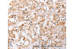 Immunohistochemistry of Human thyroid cancer using HDAC8 Polyclonal Antibody at dilution of 1:40 (HDAC8 anticorps)