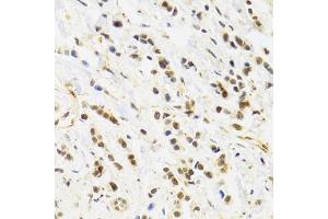 Immunohistochemistry of paraffin-embedded human breast cancer using RAD50 Antibody. (RAD50 anticorps)