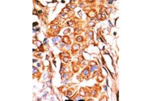 Formalin-fixed and paraffin-embedded human cancer tissue reacted with the primary antibody, which was peroxidase-conjugated to the secondary antibody, followed by AEC staining.