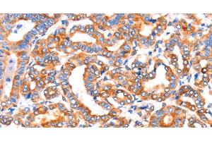 Immunohistochemistry of paraffin-embedded Human thyroid cancer tissue using SEPT4 Polyclonal Antibody at dilution 1:50 (Septin 4 anticorps)