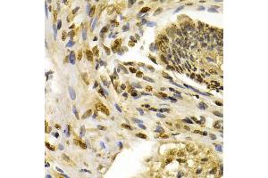 Immunohistochemistry of paraffin-embedded human esophageal cancer using IFIH1 antibody (ABIN5971229) at dilution of 1/200 (40x lens). (IFIH1 anticorps)