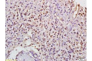 Formalin-fixed and paraffin embedded human gastric carcinoma labeled with Anti-Phospho-PKC gamma (Thr514) Polyclonal Antibody, Unconjugated (ABIN703285) at 1:200 followed by conjugation to the secondary antibody (PKC gamma anticorps  (pThr514))