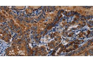 Immunohistochemistry of paraffin-embedded Human thyroid cancer tissue using PIDD1 Polyclonal Antibody at dilution 1:30 (PIDD anticorps)