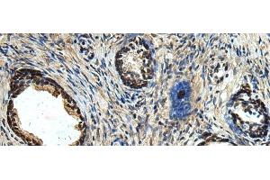 Immunohistochemistry of paraffin-embedded Human prost ate cancer tissue using ERLIN1 Polyclonal Antibody at dilution of 1:50(x200) (ERLIN1 anticorps)