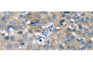 Immunohistochemistry of paraffin-embedded Human breast cancer using PBOV1 Polyclonal Antibody at dilution of 1/20 (PBOV1 anticorps)