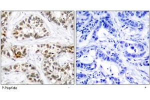 Immunohistochemical analysis of paraffin-embedded human breast carcinoma tissue using RELB (phospho S552) polyclonal antibody . (RELB anticorps  (pSer552))