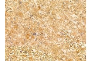 ABIN6263242 and ABIN6266551 at 1/100 staining human astrocytoma by IHC-P. (GRM7 anticorps  (C-Term))