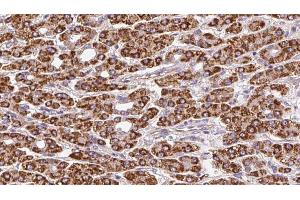 ABIN6272373 at 1/100 staining Human liver cancer tissue by IHC-P.