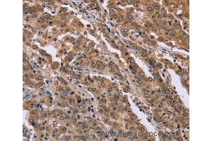 Immunohistochemistry of Human liver cancer using FAM3B Polyclonal Antibody at dilution of 1:40 (FAM3B anticorps)