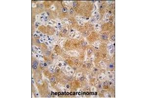 Formalin-fixed and paraffin-embedded human hepatocarcinoma tissue reacted with OA4 antibody (N-term) 7591a , which was peroxidase-conjugated to the secondary antibody, followed by DAB staining. (APOA4 anticorps  (N-Term))