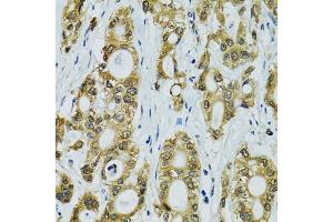 Immunohistochemistry of paraffin-embedded human rectal cancer using RPS7 antibody (ABIN5974069) at dilution of 1/100 (40x lens). (RPS7 anticorps)