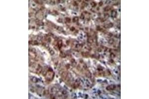 Formalin fixed and paraffin embedded human liver tissue stained with DARS1 Antibody (N-term) followed by peroxidase conjugation of the secondary antibody and DAB staining.