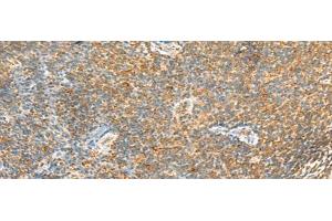 Immunohistochemistry of paraffin-embedded Human tonsil tissue using MTHFD2L Polyclonal Antibody at dilution of 1:30(x200) (MTHFD2L anticorps)