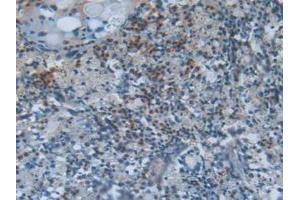 IHC-P analysis of Human Lung Cancer Tissue, with DAB staining. (SCGB1A1 anticorps  (AA 23-91))